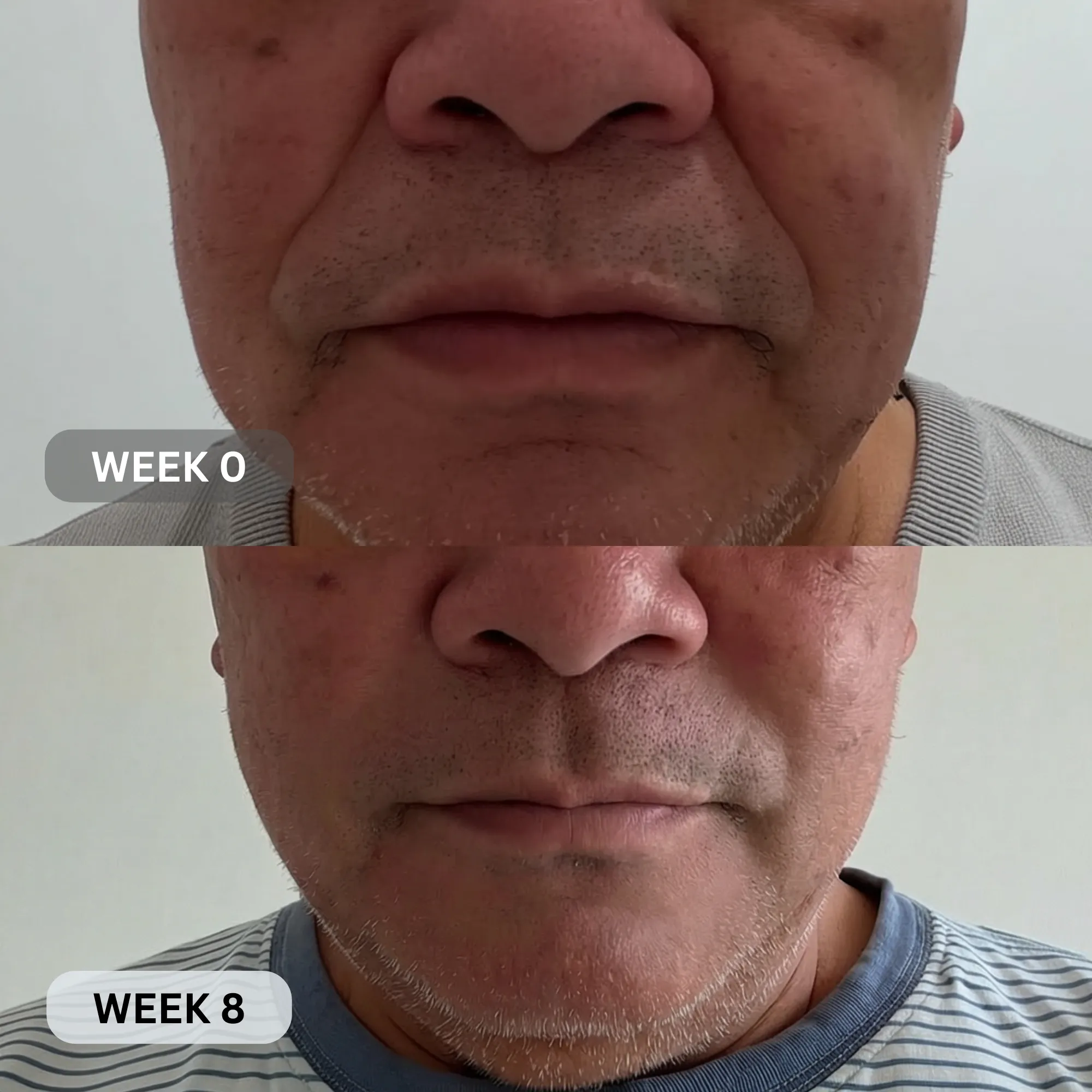 Micro-Infusion System For Smile Lines (Men) - Image 10