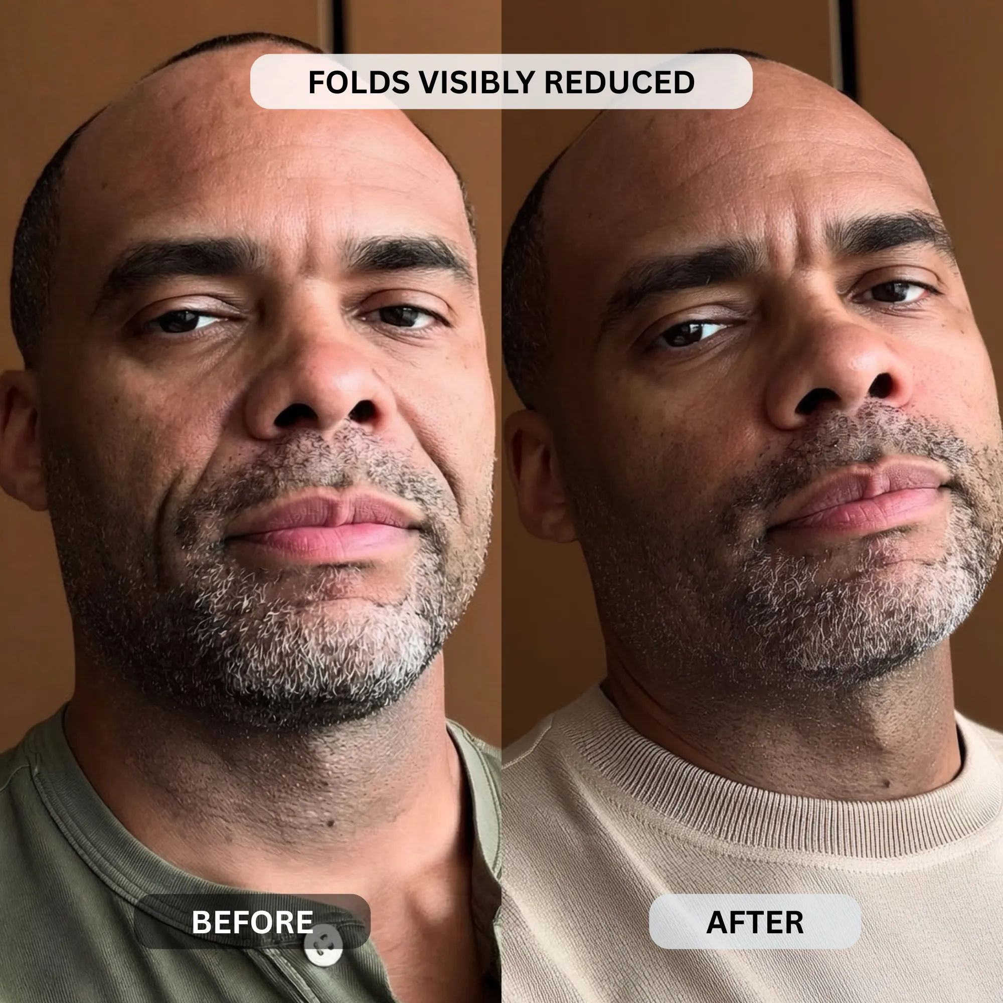Micro-Infusion System For Smile Lines (Men) - Image 12