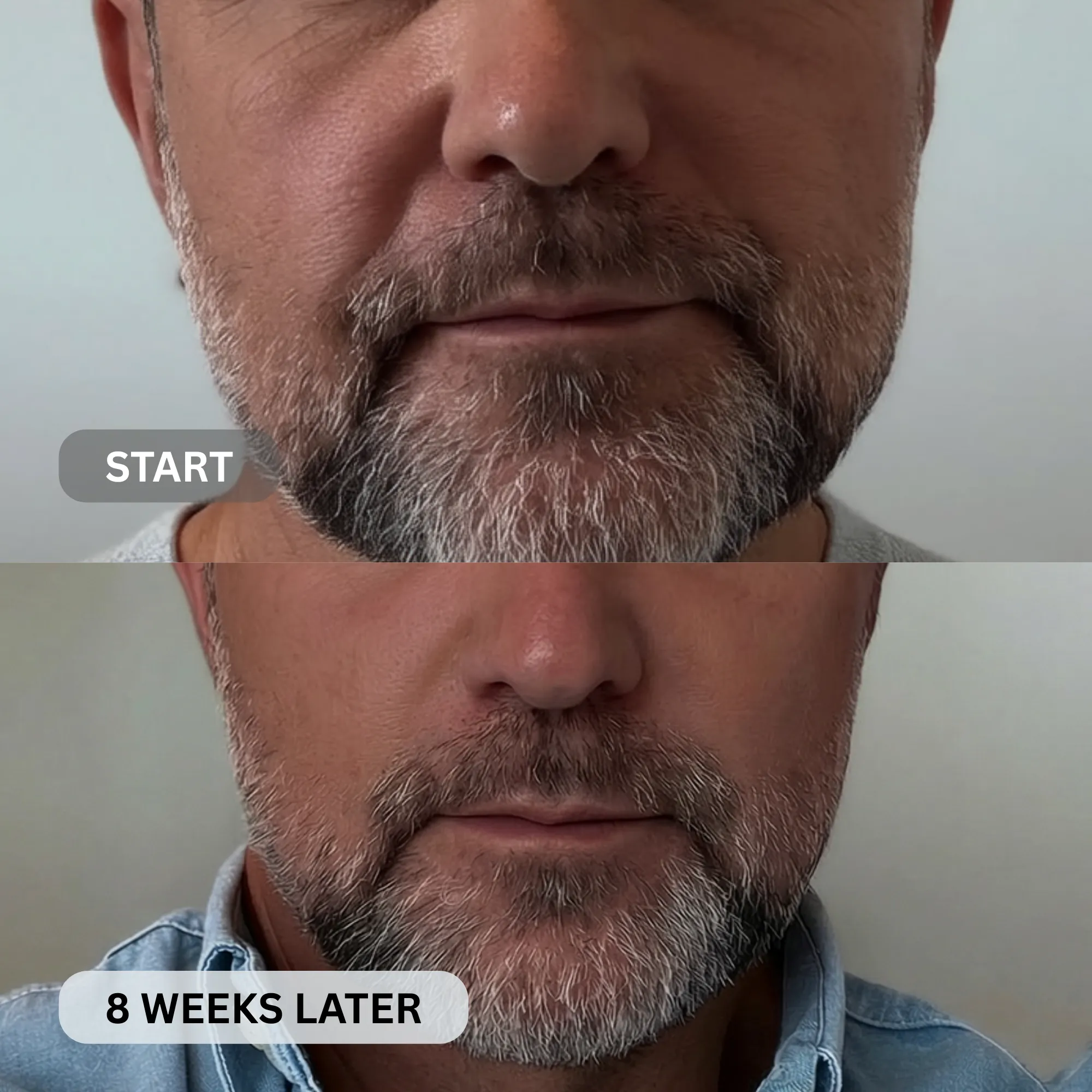 Micro-Infusion System For Smile Lines (Men) - Image 13