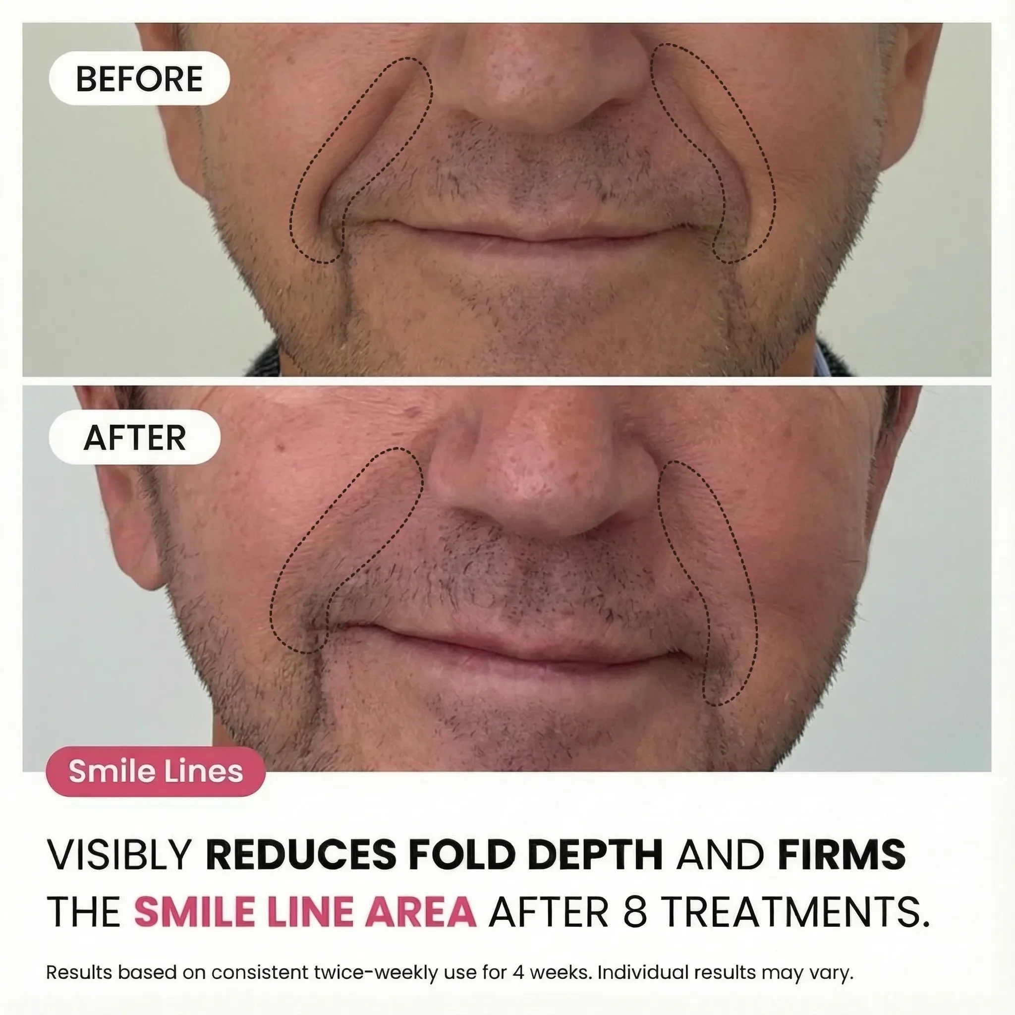 Micro-Infusion System For Smile Lines (Men) - Image 2