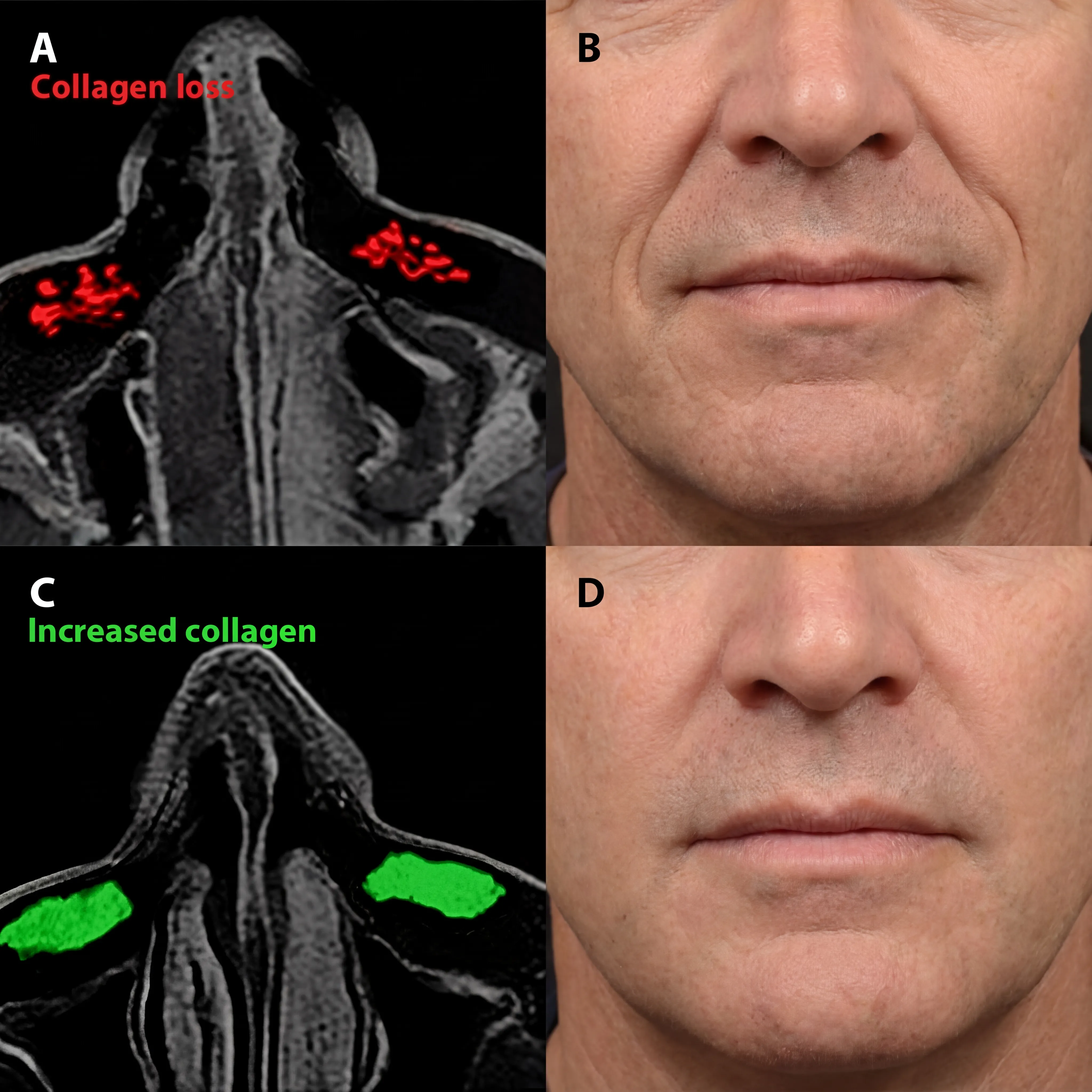 Micro-Infusion System For Smile Lines (Men) - Image 3