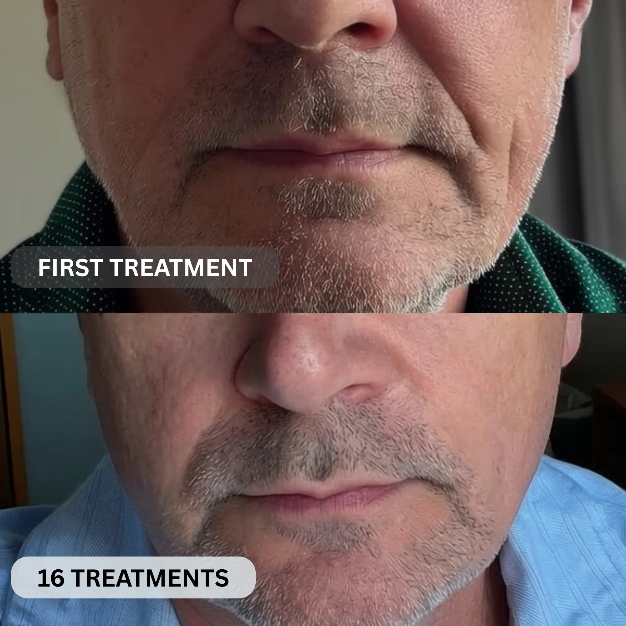 Micro-Infusion System For Smile Lines (Men) - Image 7