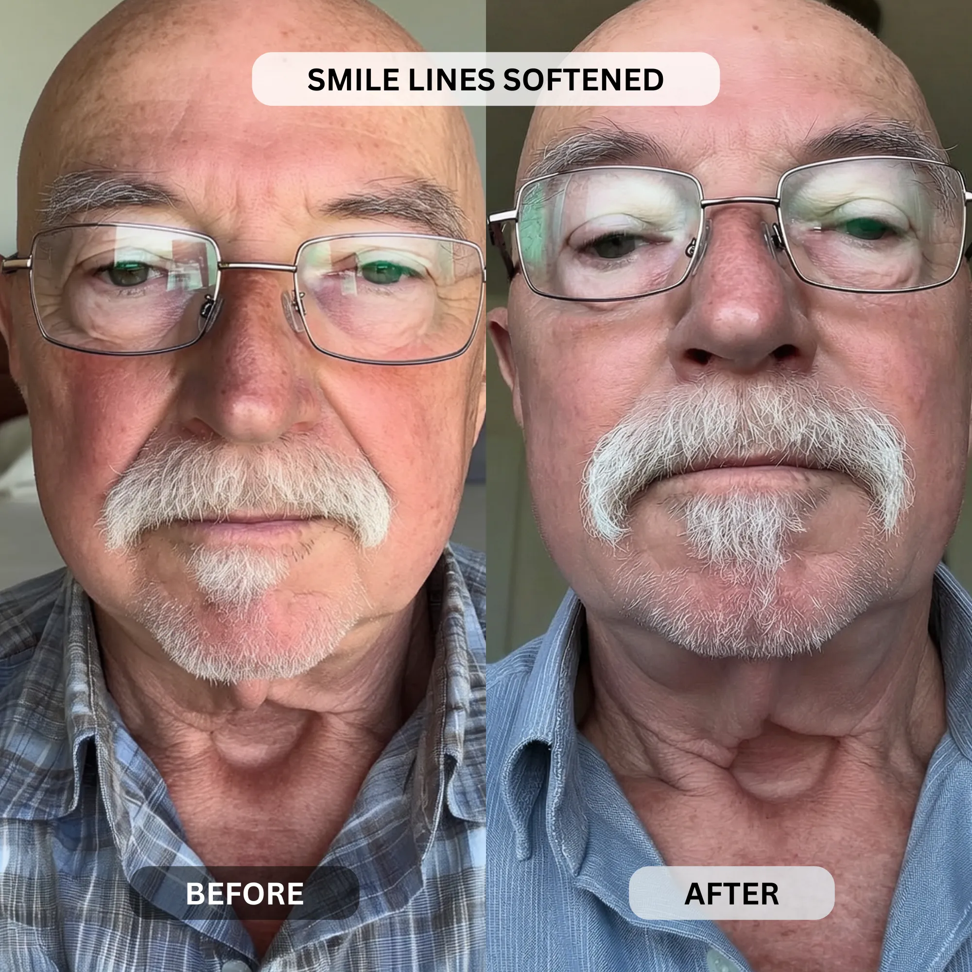 Micro-Infusion System For Smile Lines (Men) - Image 9