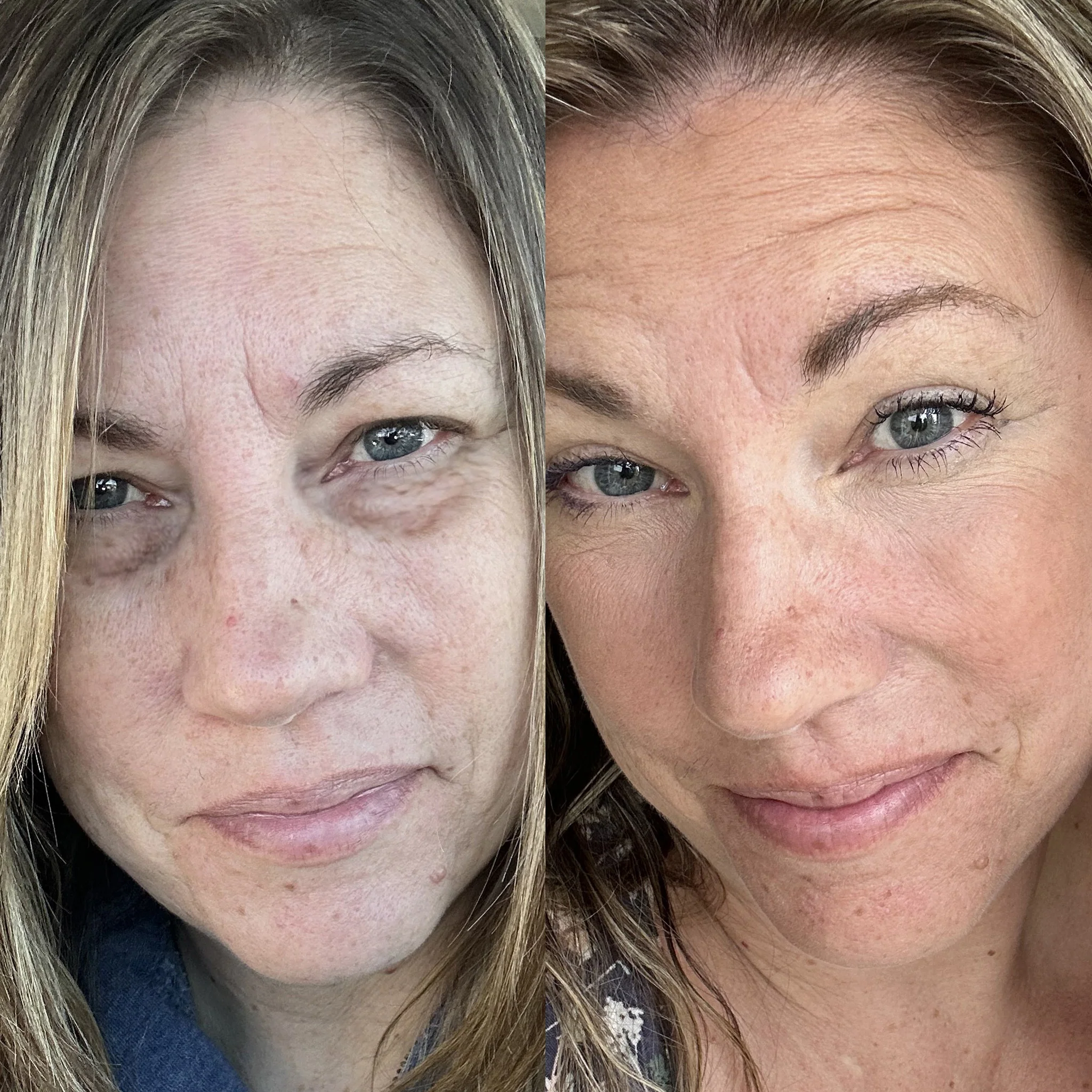RevitalEyes® 2-in-1 Red Light Therapy & EMS Microcurrents For Eye Bags - Image 6