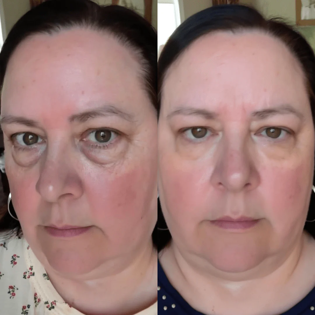 RevitalEyes® — Red Light & EMS Device for Hormone-Related Under-Eye Puffiness - Image 4