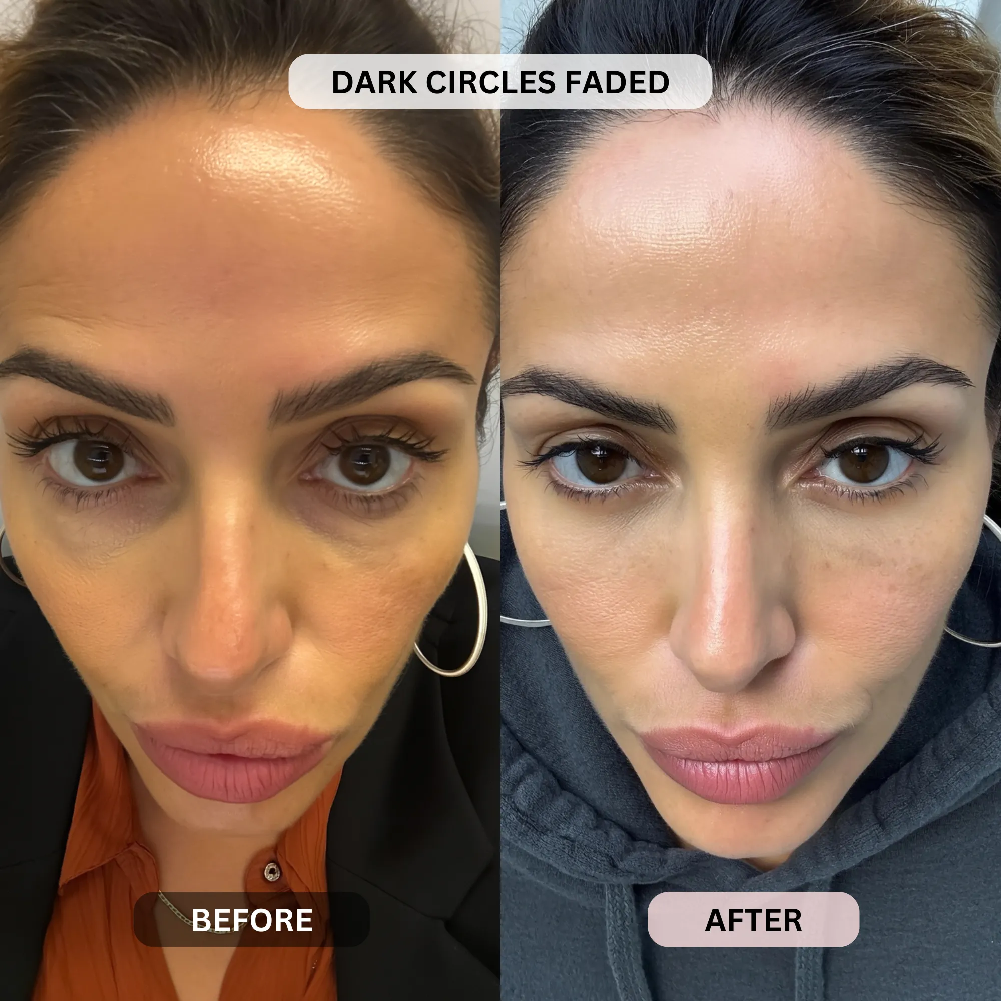 Micro-Infusion System For Under Eyes - Image 10