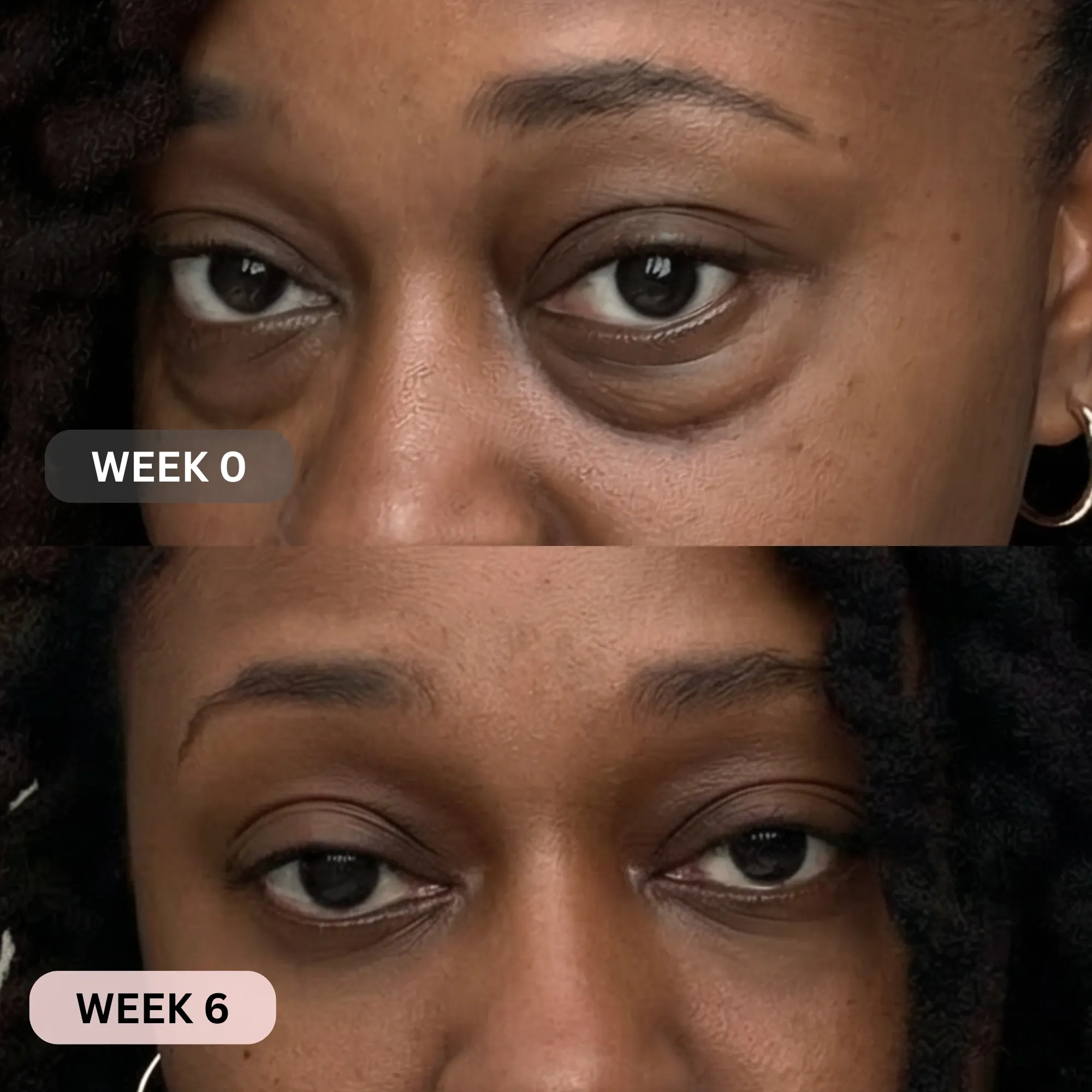 Micro-Infusion System For Under Eyes - Image 11