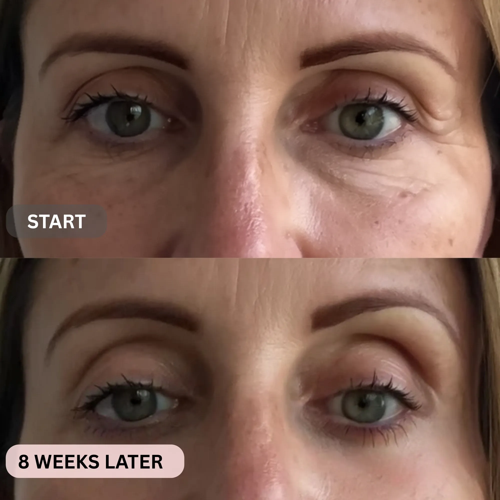Micro-Infusion System For Under Eyes - Image 14
