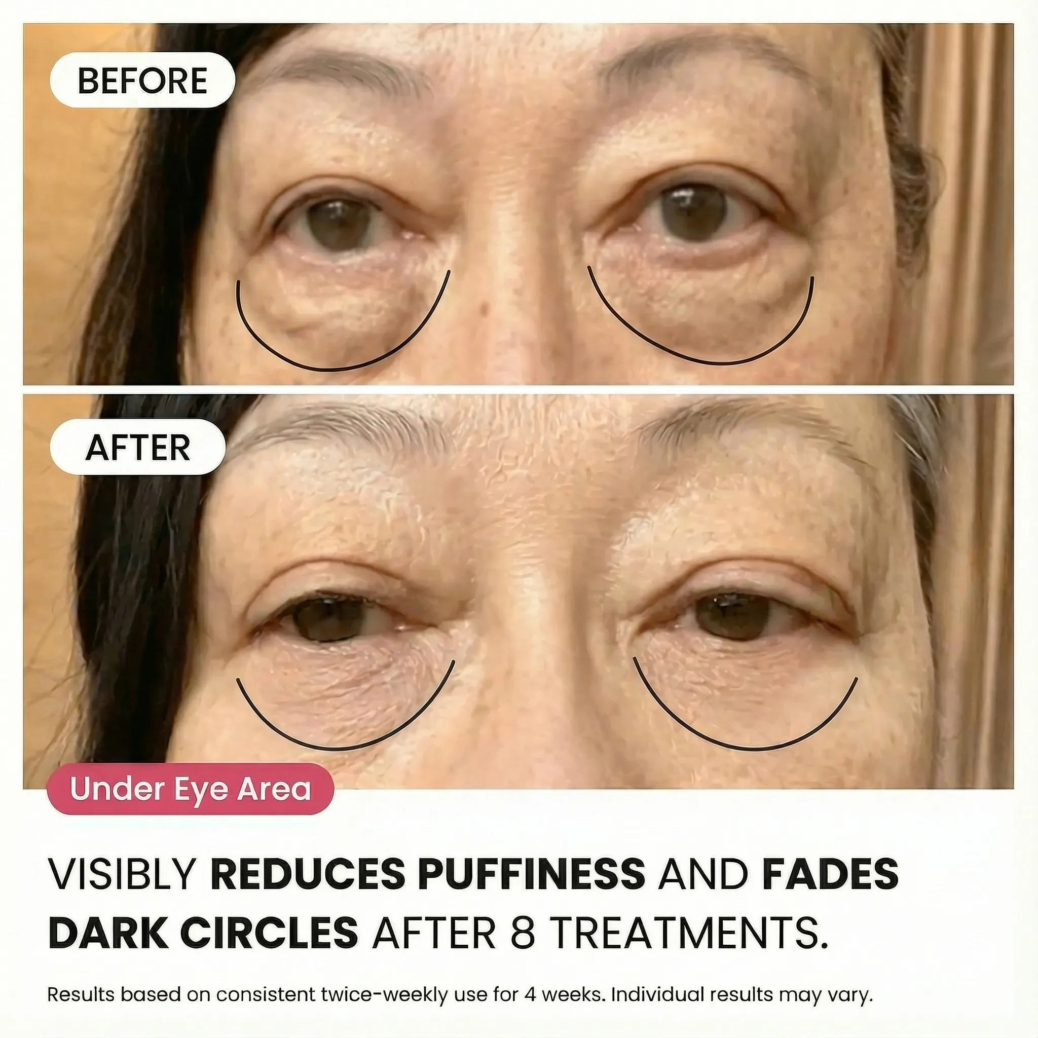 Micro-Infusion System For Under Eyes - Image 3