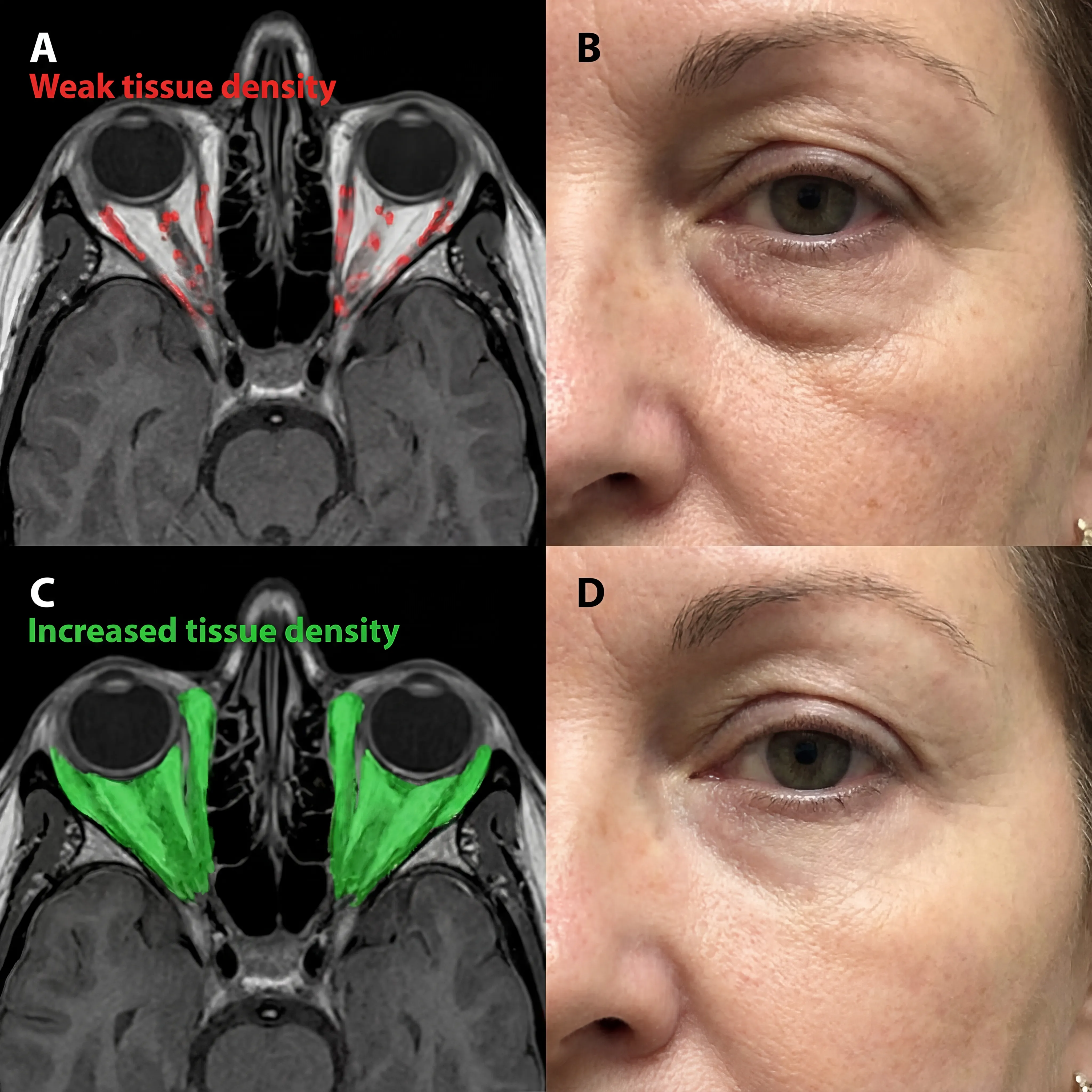 Micro-Infusion System For Under Eyes - Image 4