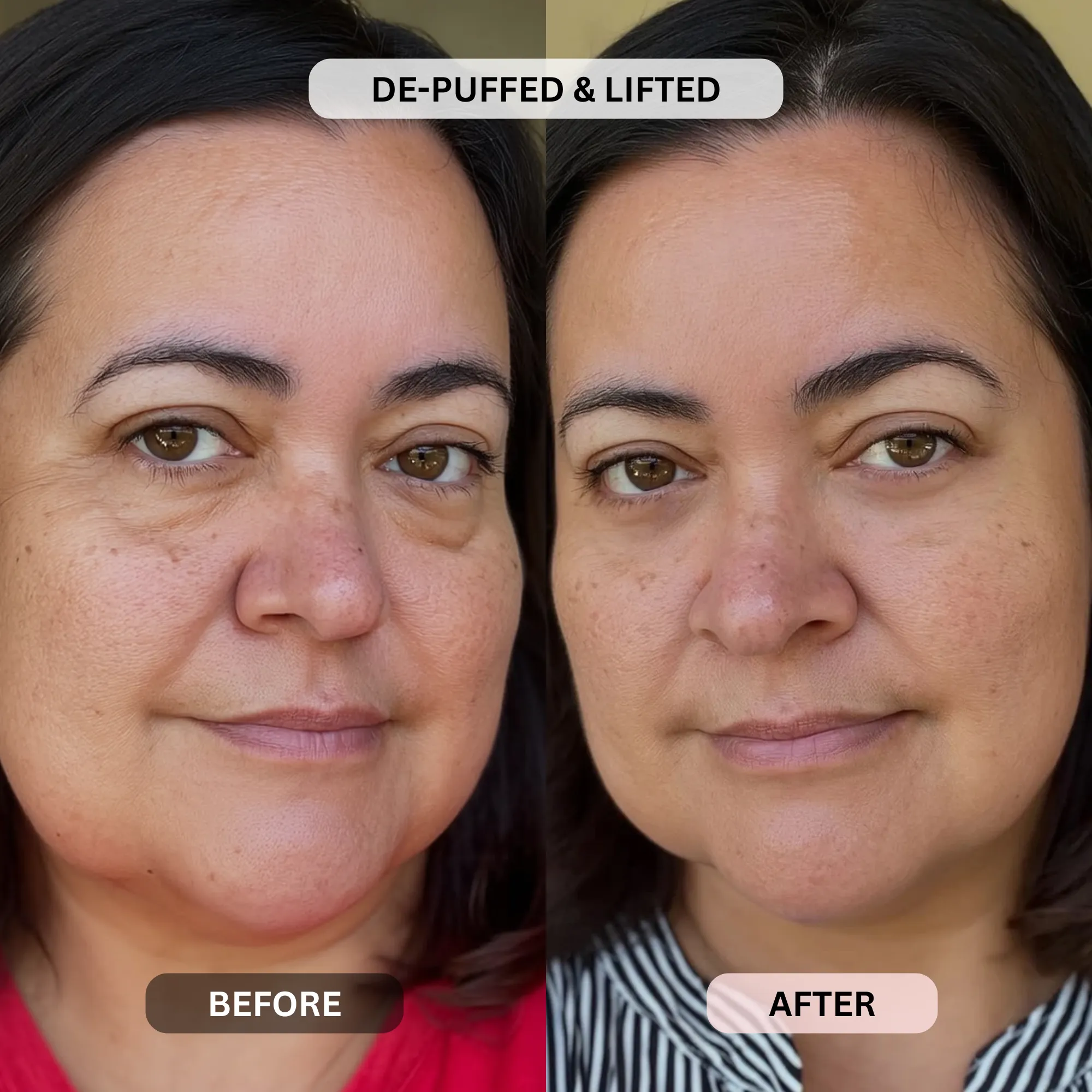 Micro-Infusion System For Under Eyes - Image 5