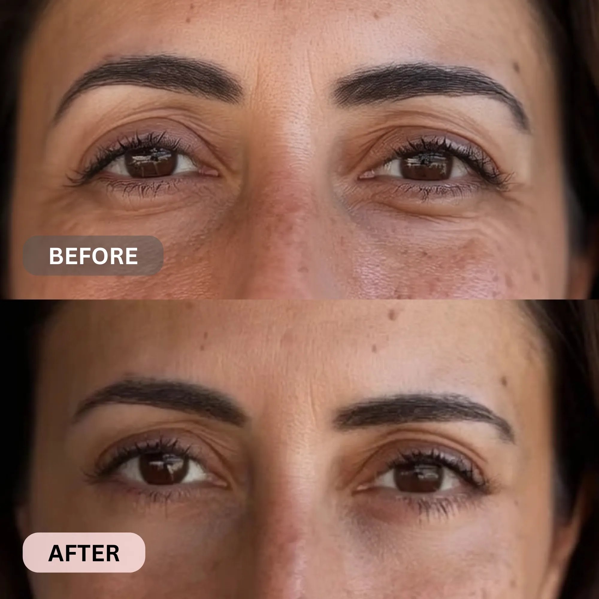 Micro-Infusion System For Under Eyes - Image 8